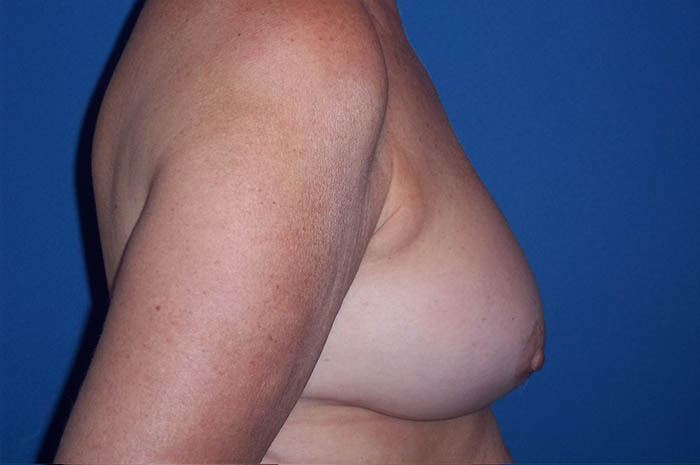 Breast Implant Revision Before & After Image