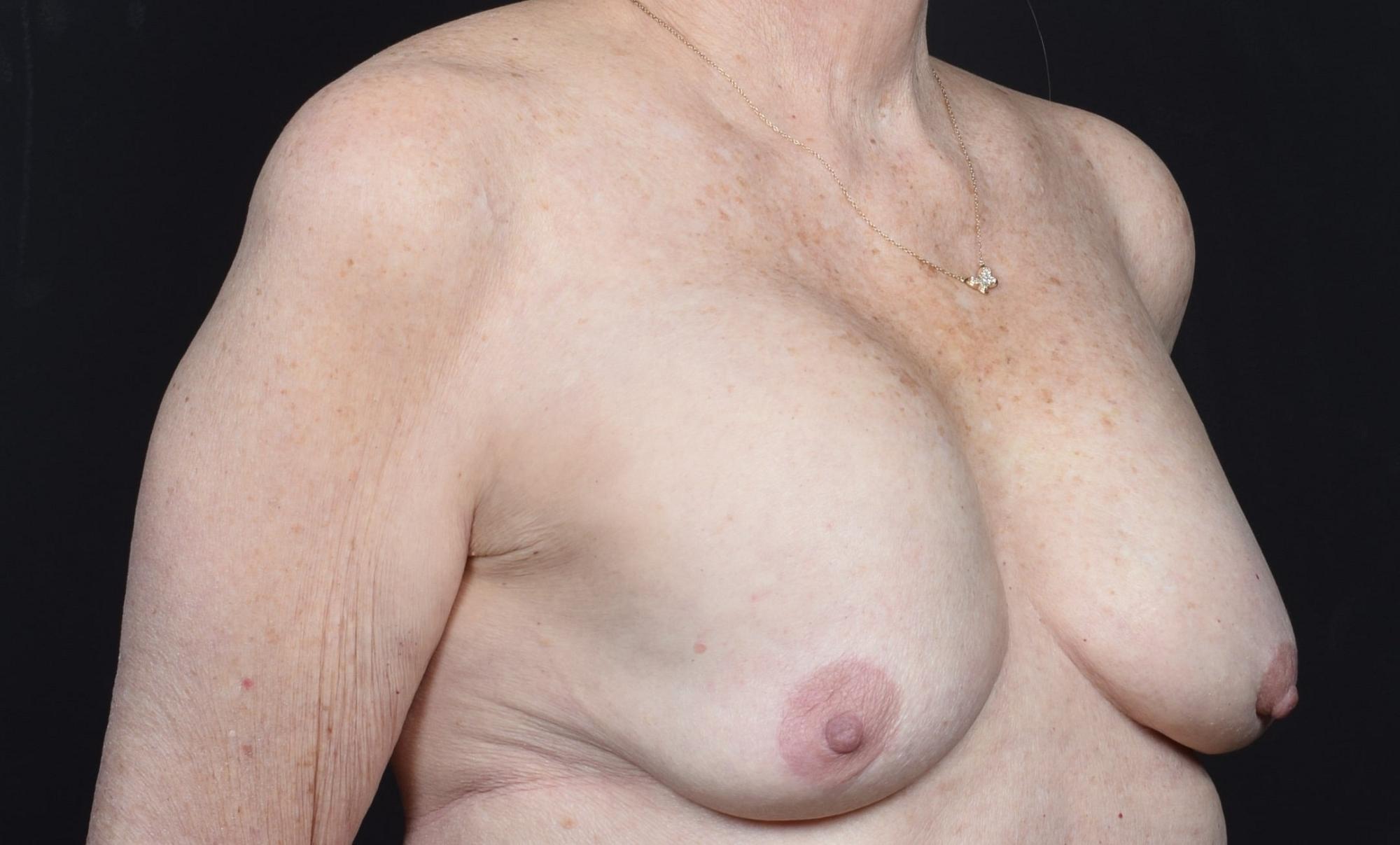 Breast Implant Removal Before & After Image