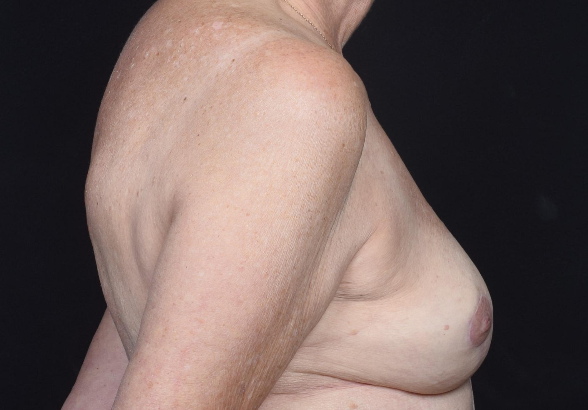 Breast Implant Removal Before & After Image