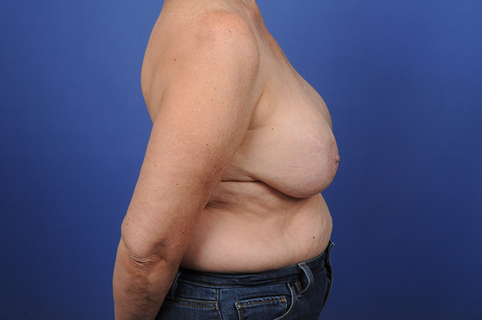 Breast Implant Removal Before & After Image