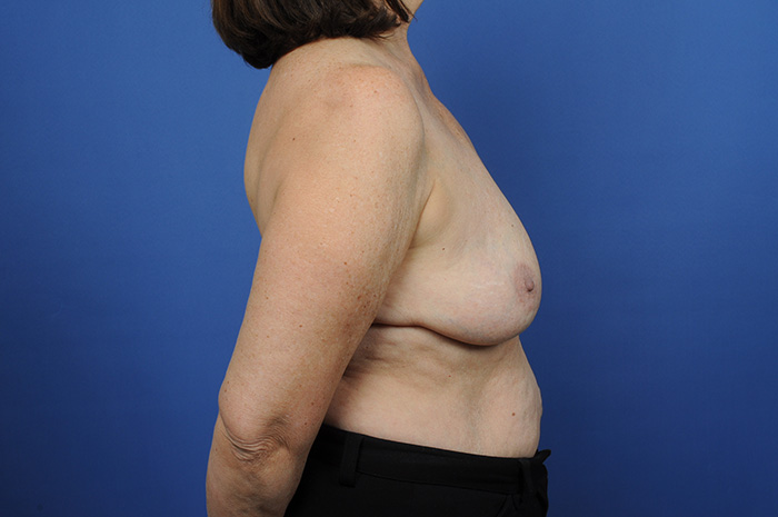 Breast Implant Removal Before & After Image