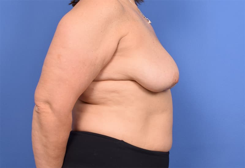 Breast Implant Removal Before & After Image