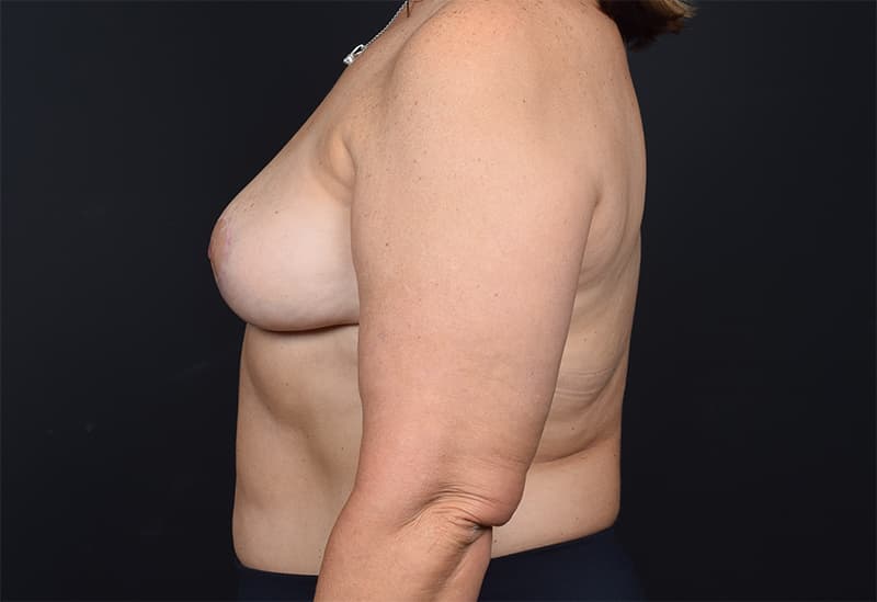 Breast Implant Removal Before & After Image