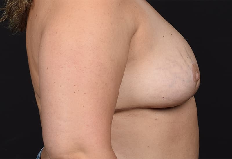 Breast Implant Removal Before & After Image