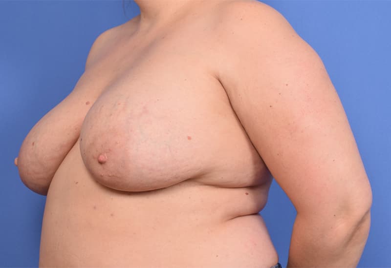 Breast Implant Removal Before & After Image