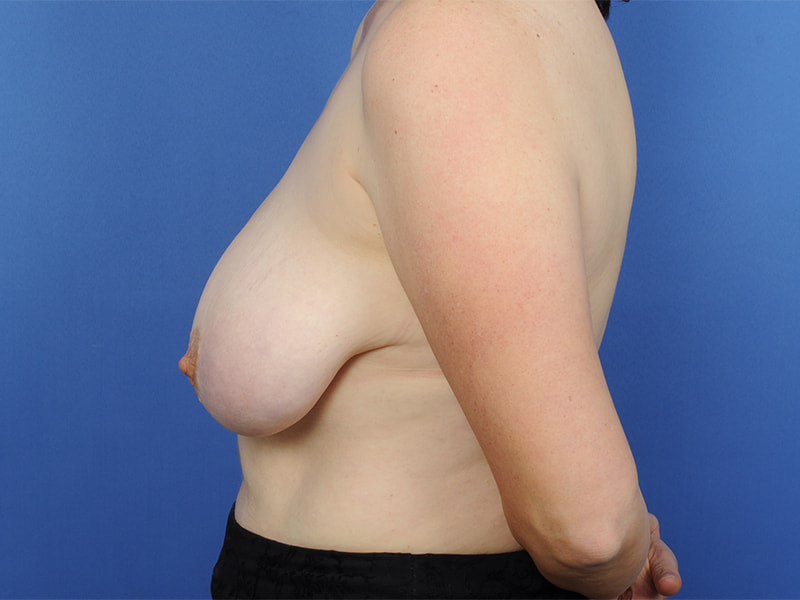 Breast Lift Before & After Image