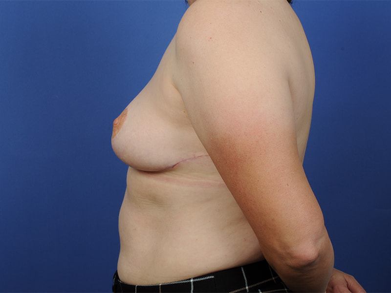 Breast Lift Before & After Image