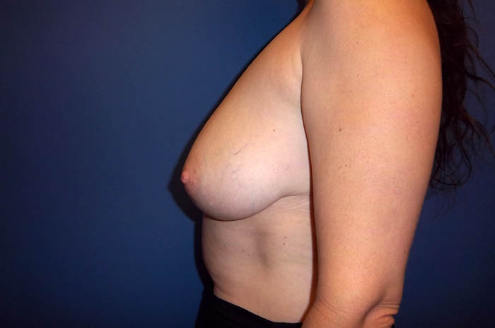 Breast Lift Before & After Image