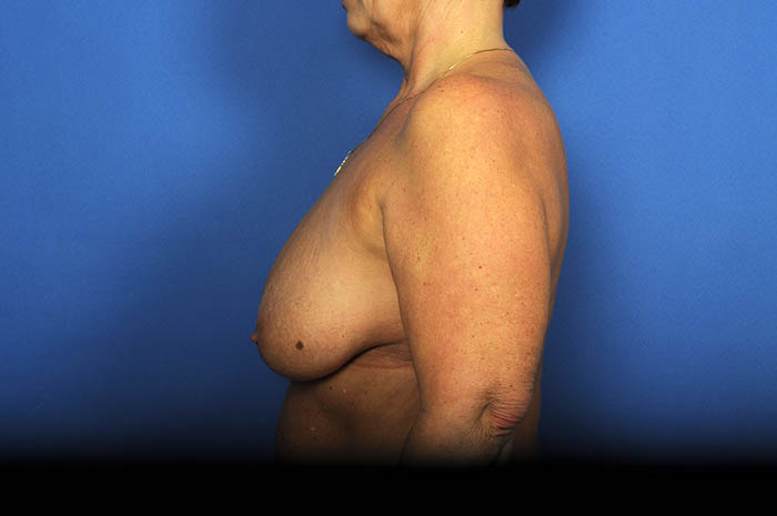 Breast Lift Before & After Image