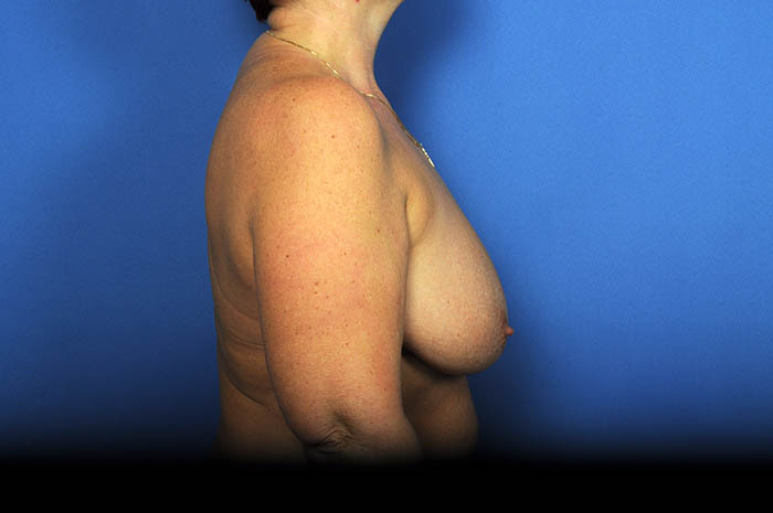 Breast Lift Before & After Image