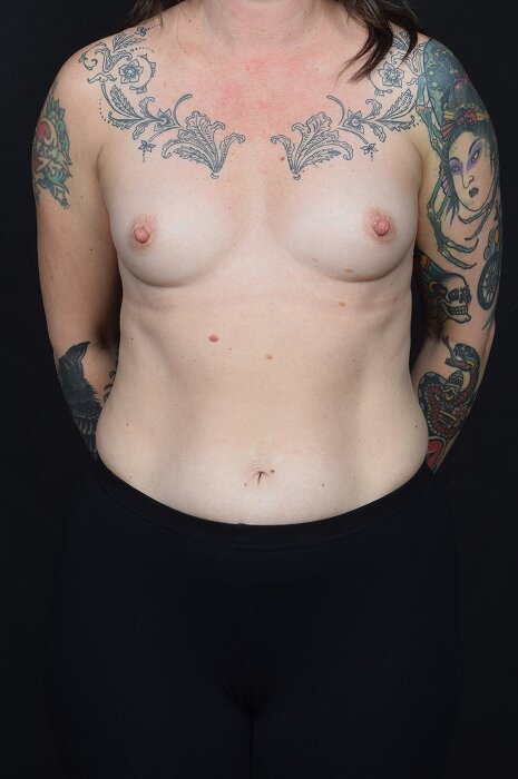 Breast Reconstruction Before & After Image