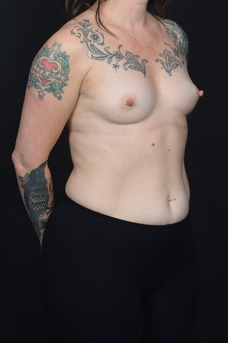 Breast Reconstruction Before & After Image