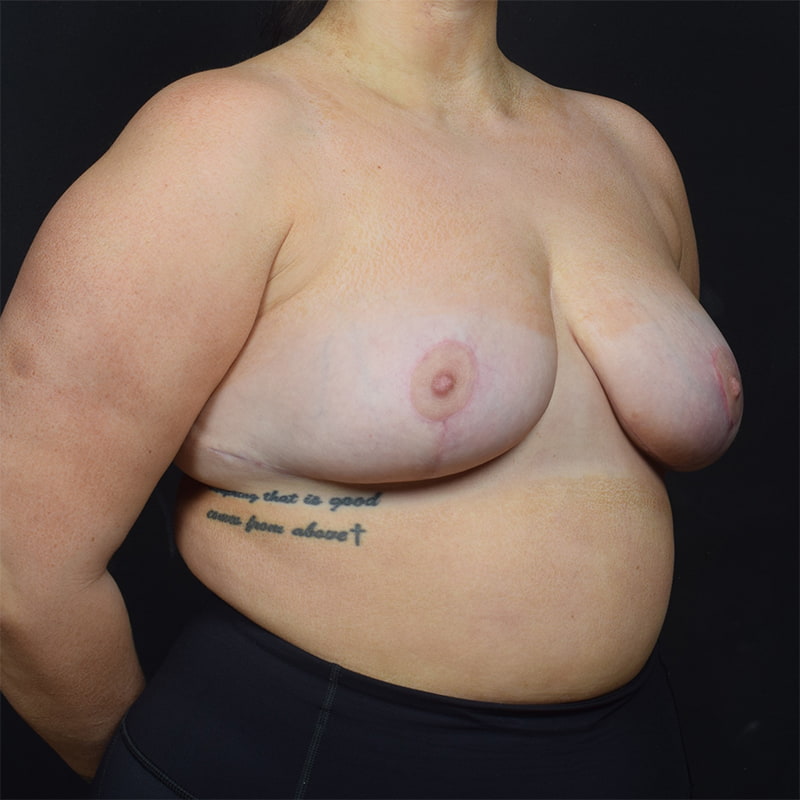 Breast Reduction Before & After Image