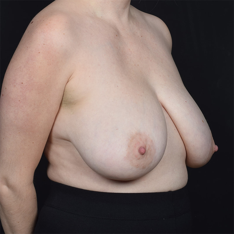 Breast Reduction Before & After Image