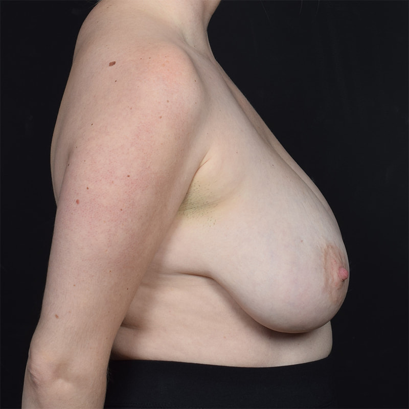 Breast Reduction Before & After Image