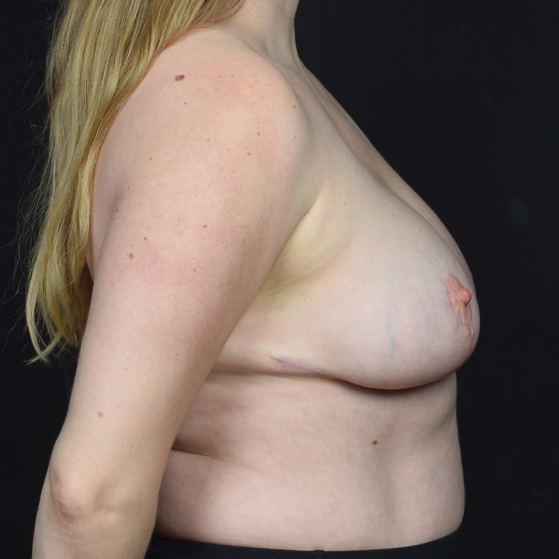 Breast Reduction Before & After Image