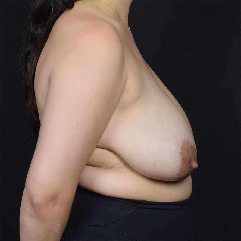 Breast Reduction Before & After Image