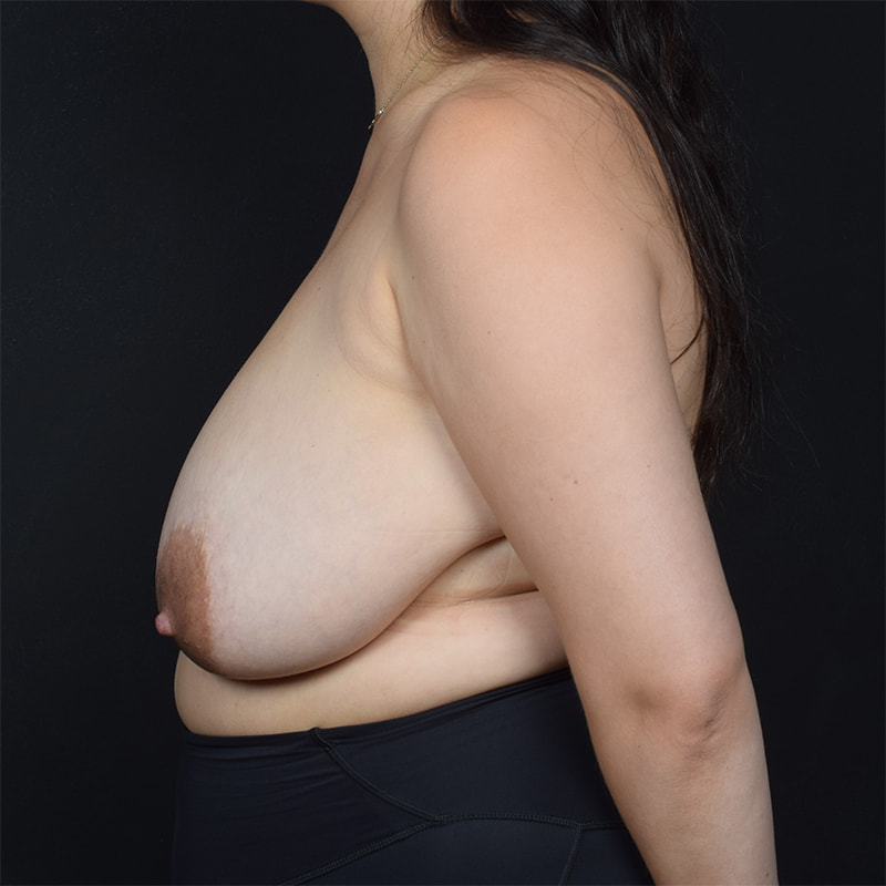 Breast Reduction Before & After Image