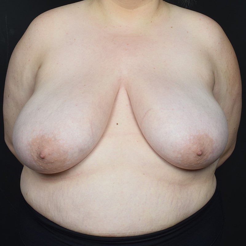 Breast Reduction Before & After Image