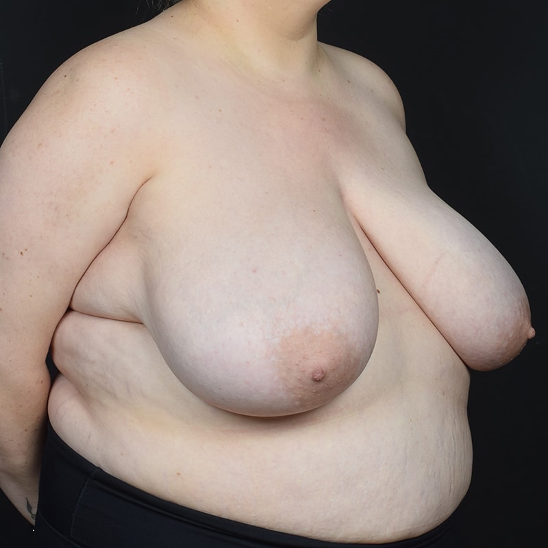 Breast Reduction Before & After Image