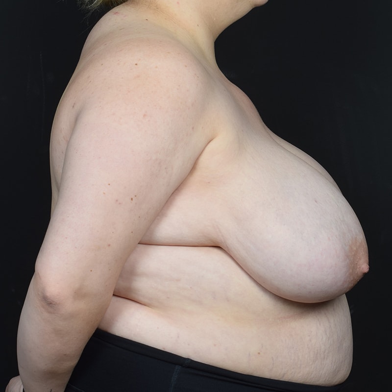 Breast Reduction Before & After Image