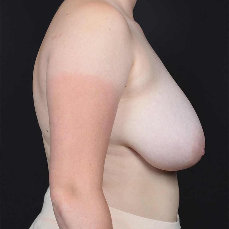 Breast Reduction Before & After Image