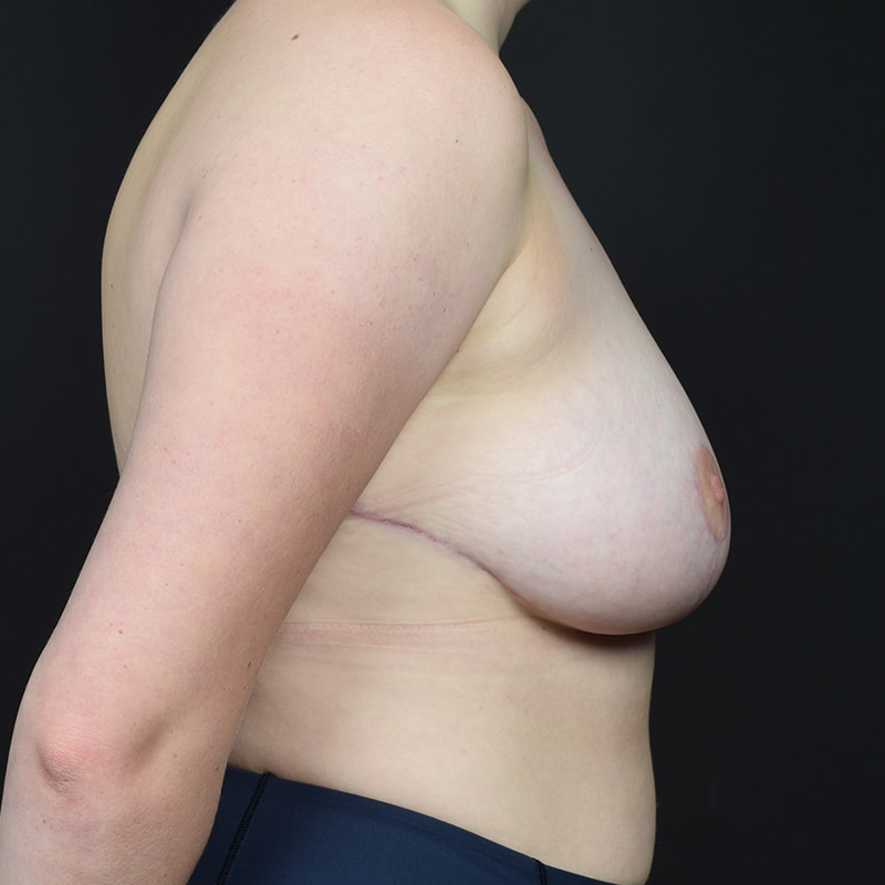 Breast Reduction Before & After Image