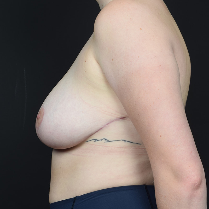 Breast Reduction Before & After Image