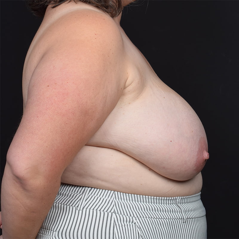 Breast Reduction Before & After Image