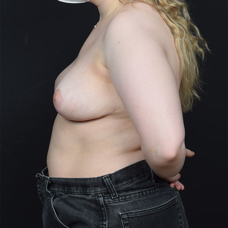 Breast Reduction Before & After Image