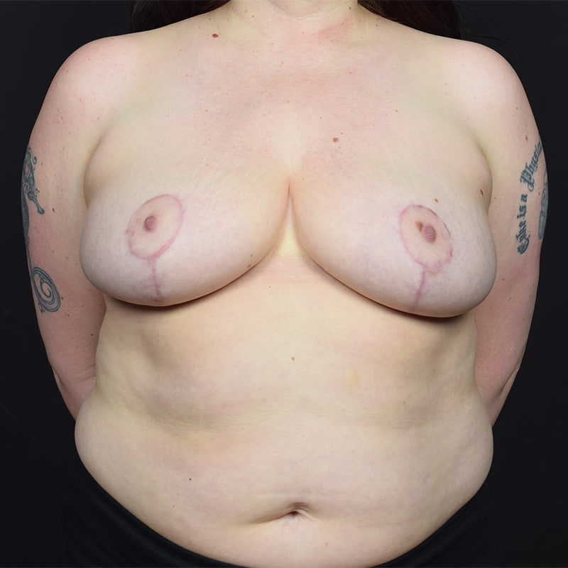 Breast Reduction Before & After Image