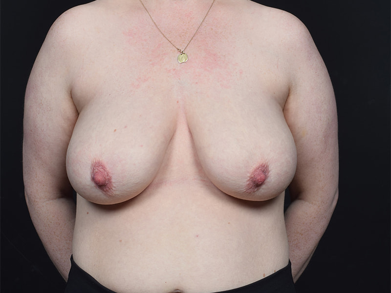 Breast Reduction Before & After Image