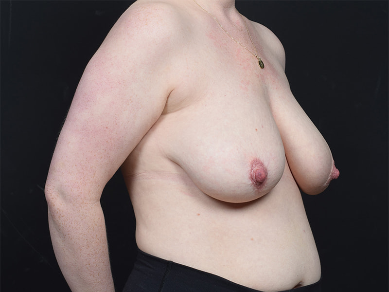 Breast Reduction Before & After Image