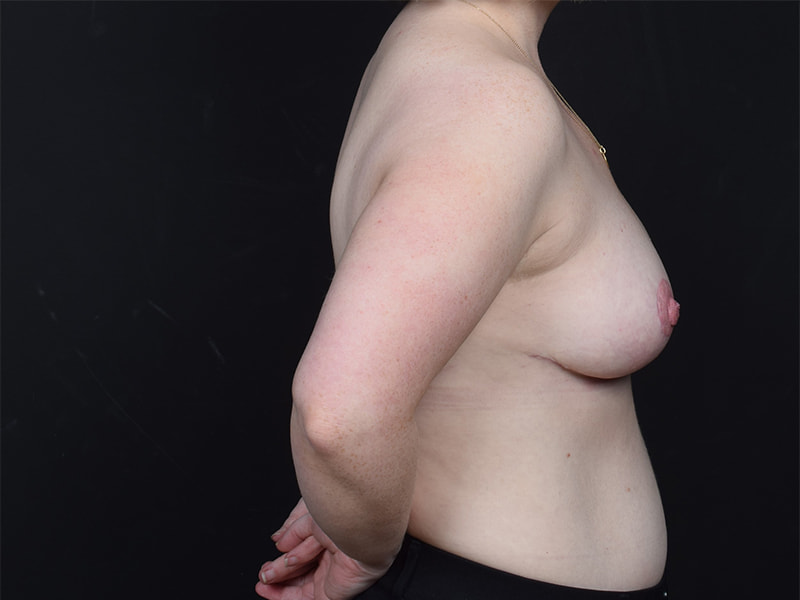 Breast Reduction Before & After Image