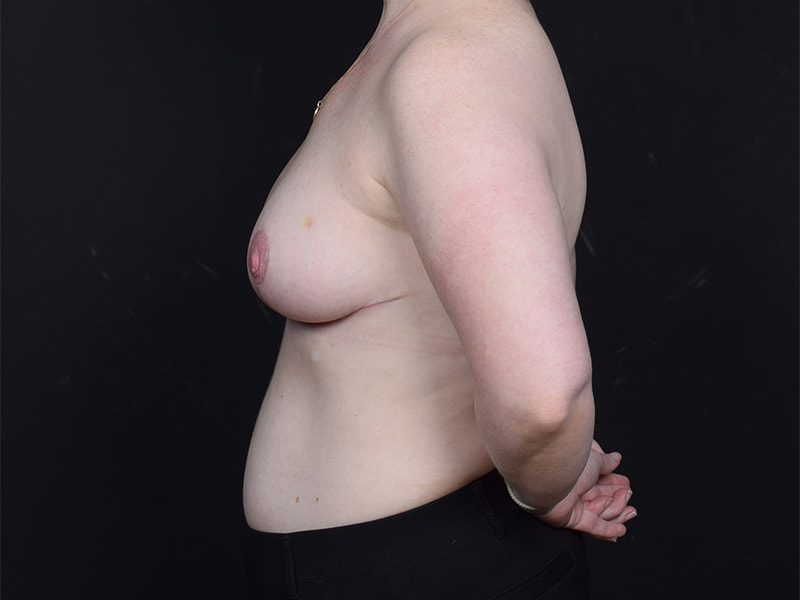 Breast Reduction Before & After Image