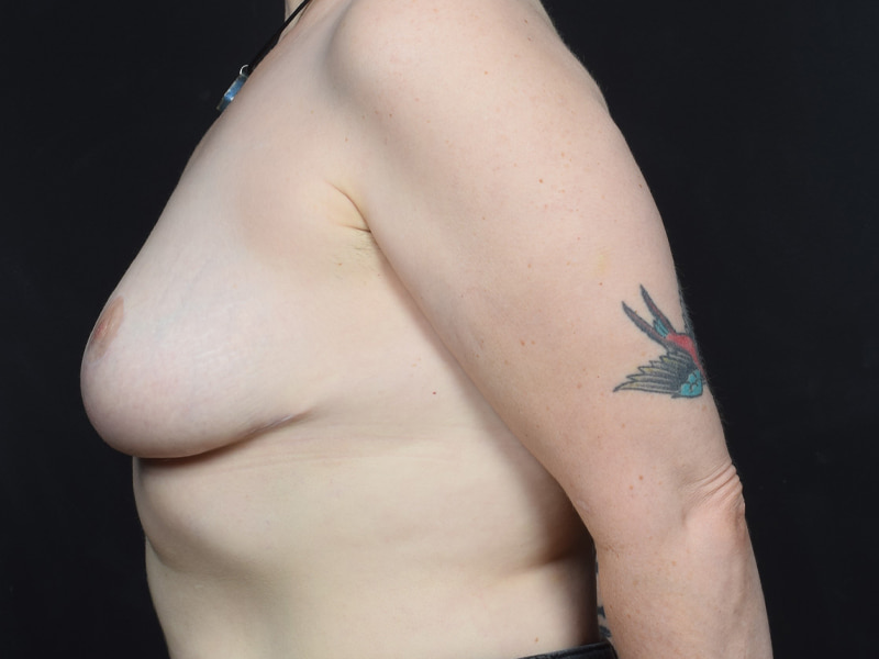 Breast Reduction Before & After Image