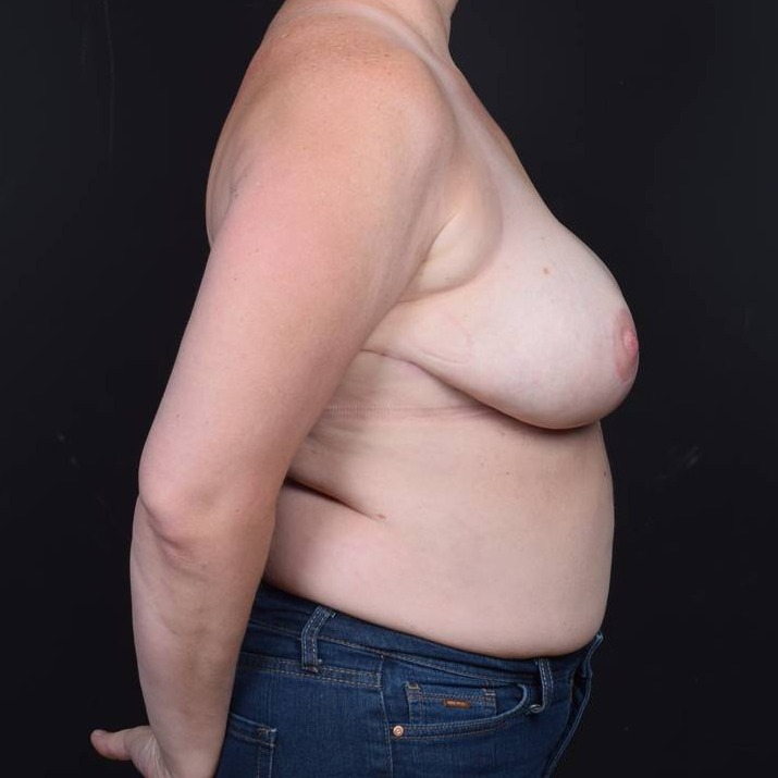 Breast Reduction Before & After Image