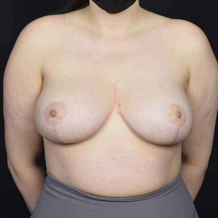 Breast Reduction Before & After Image