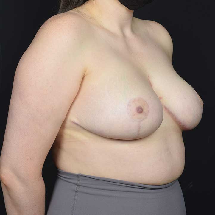 Breast Reduction Before & After Image