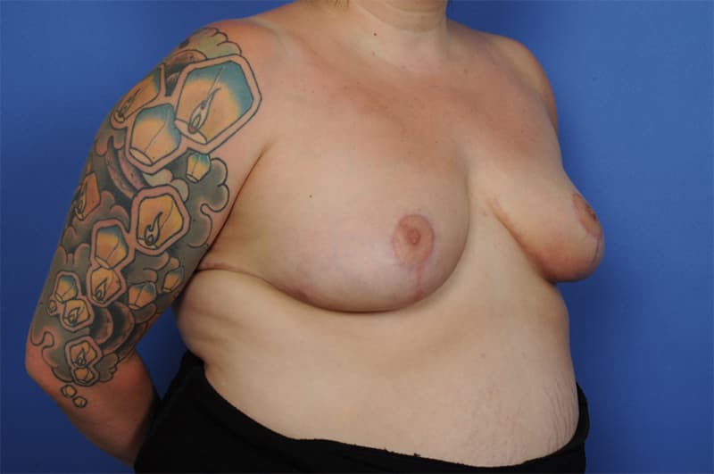 Breast Reduction Before & After Image