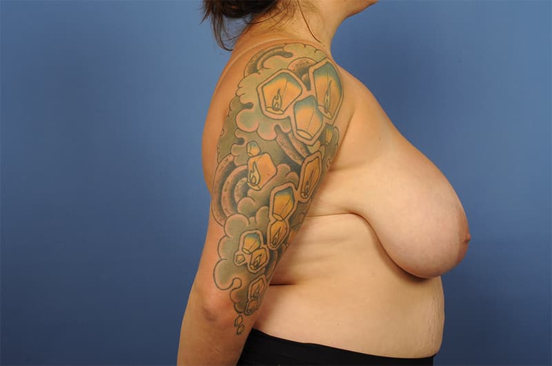 Breast Reduction Before & After Image