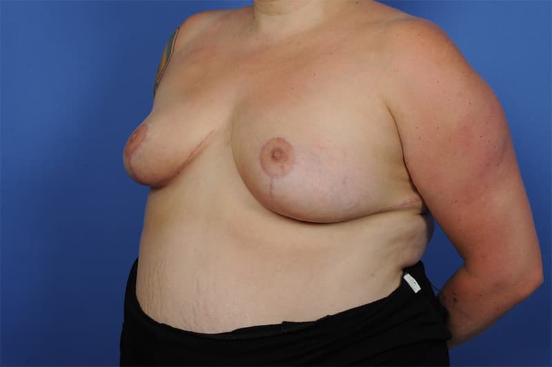 Breast Reduction Before & After Image