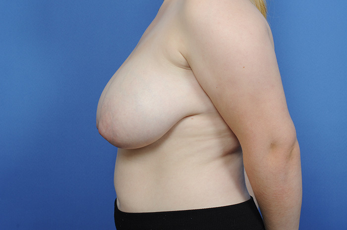 Breast Reduction Before & After Image