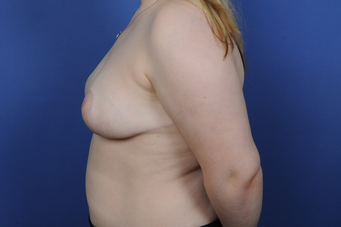 Breast Reduction Before & After Image