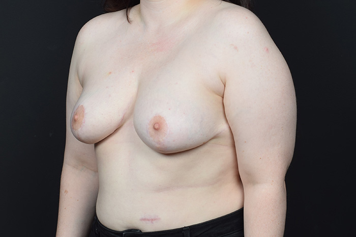 Breast Reduction Before & After Image