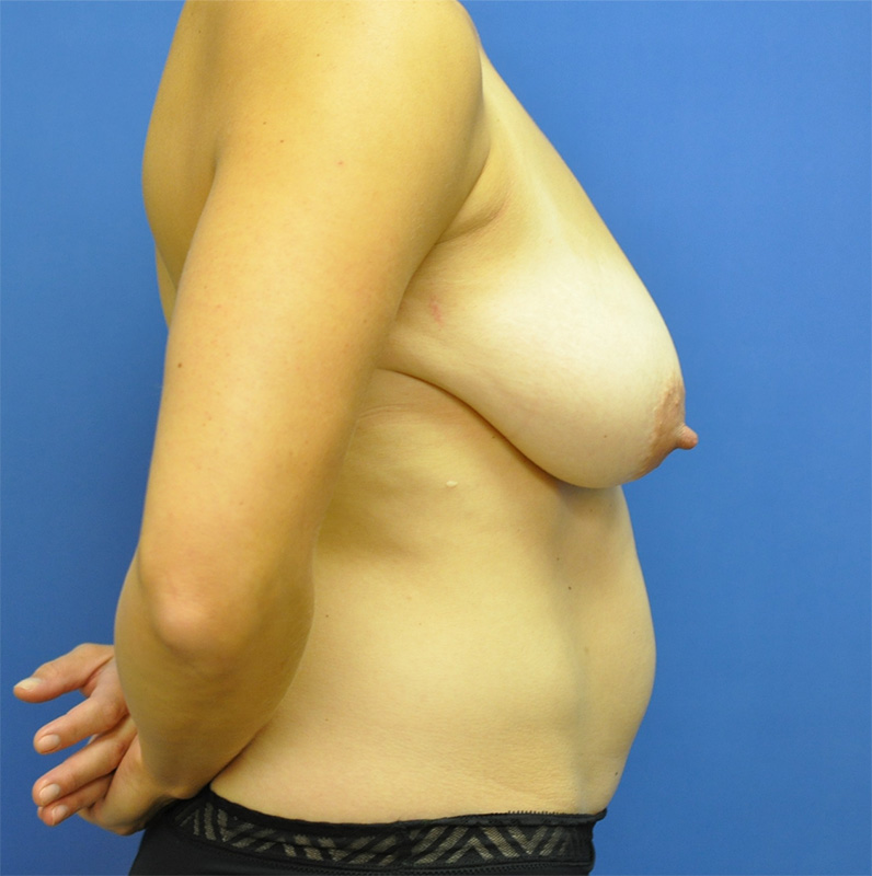 Breast Reduction Before & After Image