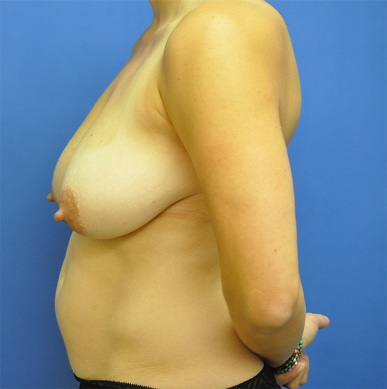 Breast Reduction Before & After Image