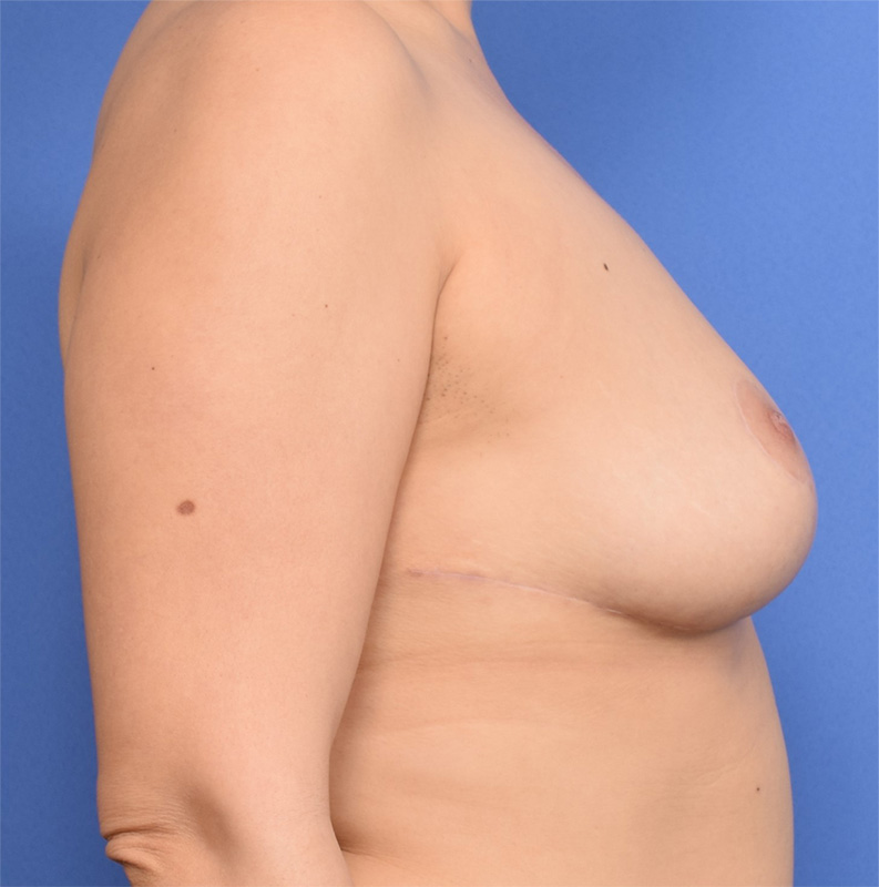 Breast Reduction Before & After Image