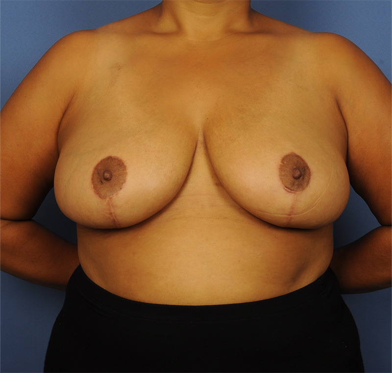 Breast Reduction Before & After Image