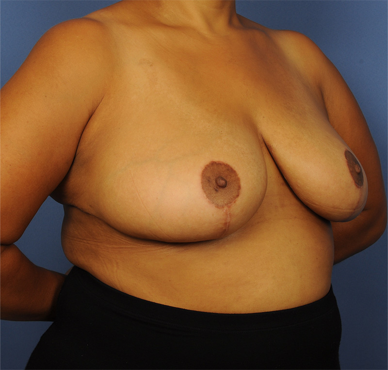 Breast Reduction Before & After Image